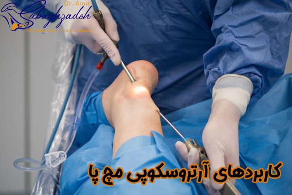 کاربردهای آرتروسکوپی مچ پا