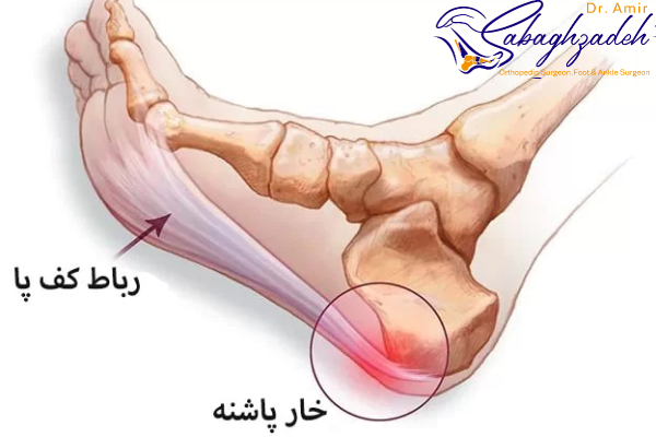 روشهای درمان خار پاشنه پا