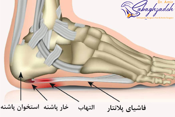 علائم خار پاشنه پا