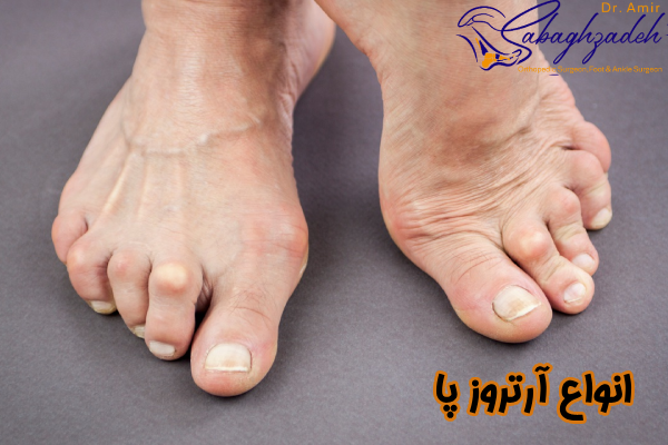 انواع آرتروز پا