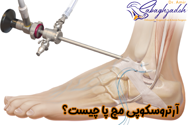 آرتروسکوپی مچ پا چیست