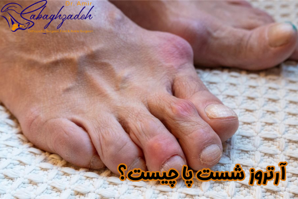 آرتروز شست پا چیست