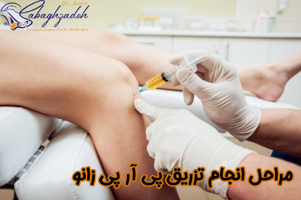 مراحل انجام تزریق پی آر پی زانو