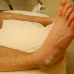دررفتگی مچ پا