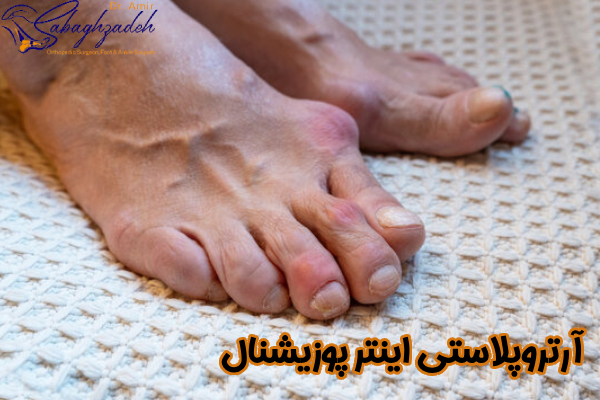 آرتروپلاستی اینتر پوزیشنال