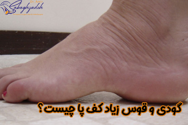 گودی کف پا چیست