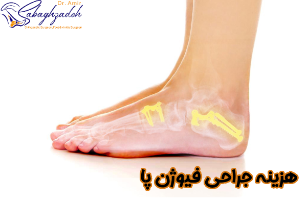 هزینه جراحی فیوژن پا چیست