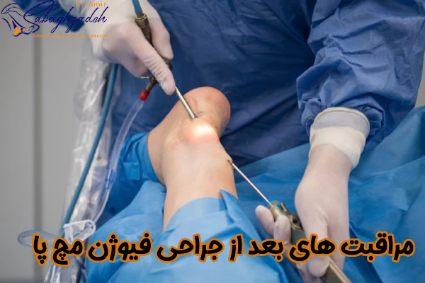 مراقبت بعد از جراحی فیوژن مچ پا