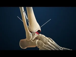 عوارض جراحی فیوژن مچ پا