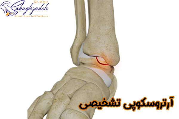 آرتروسکوپی تشخیصی
