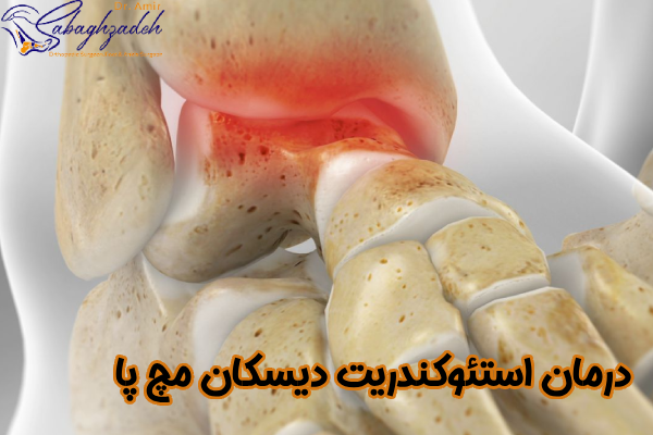 درمان او سی دی تالوس