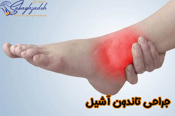 جراحی تاندون آشیل