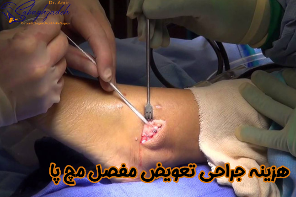 هزینه جراحی تعویض مفصل مچ پا